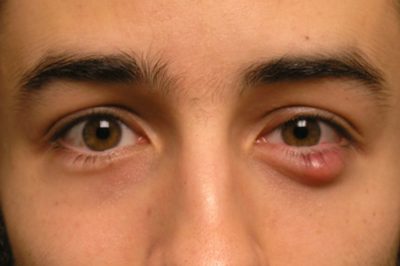 Lẹo mắt tình trạng phổ biến hay gặp
